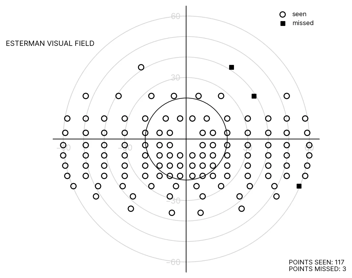 Esterman binocular visual field result: 120 test points on a polar grid out to 60 degrees, 117 seen and 3 missed