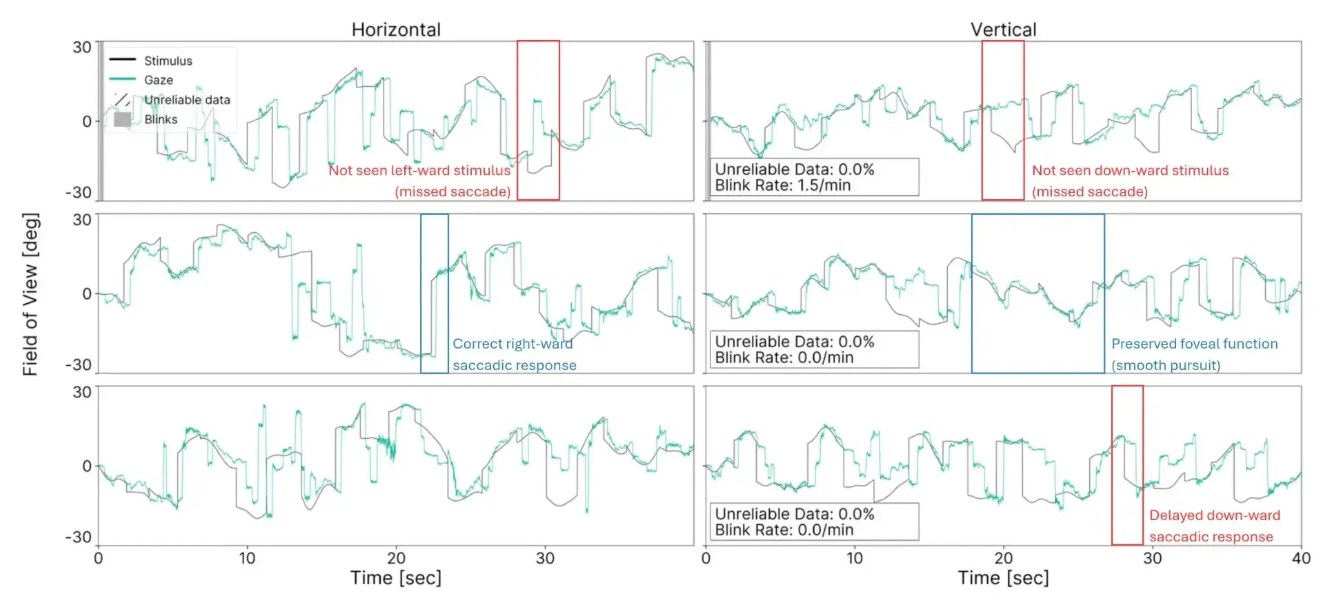 Horizontal and vertical gaze traces against the presented stimulus across three test runs, annotated with missed saccades, correct saccadic responses, preserved foveal function, and a delayed saccadic response