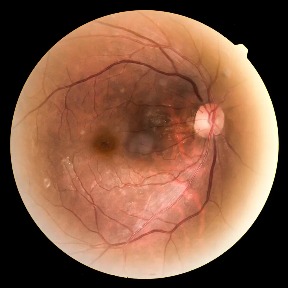 Colour fundus photograph of a retina, with the optic disc and macula visible