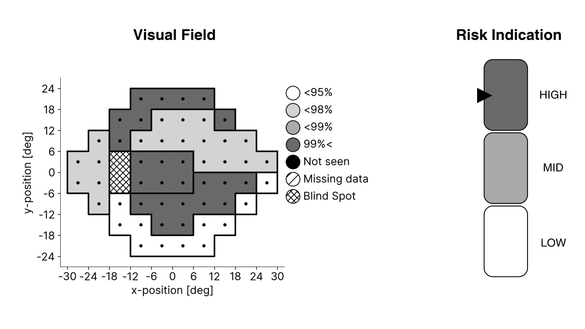 Sample SONDA report: a visual field density map alongside a HIGH/MID/LOW glaucoma risk indication gauge